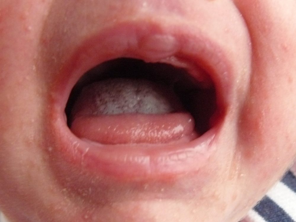 Lipbandjes Archives Tongriem Kliniek