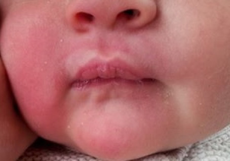 Lipbandjes Archives Tongriem Kliniek